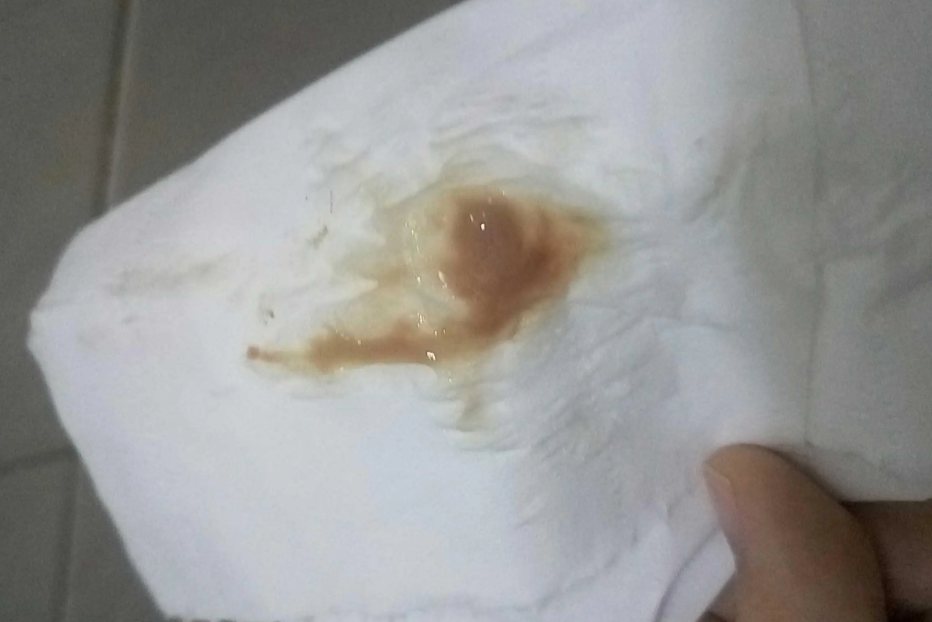 子宫颈炎分泌物