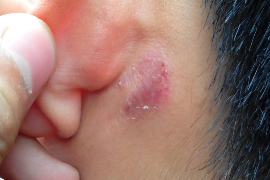 耳朵脂溢性皮炎