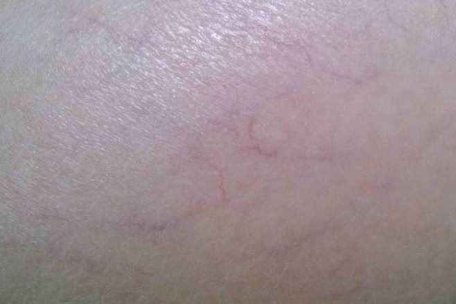 生理性毛细血管扩张