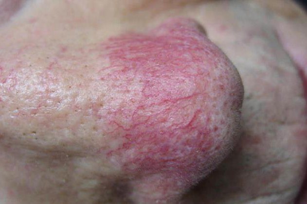 红斑毛细血管扩张型玫瑰痤疮