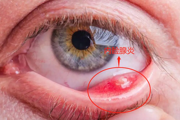 内睑腺炎