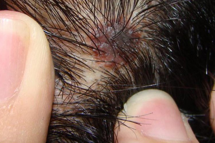 皮肤上颜色特异的黑色素瘤图