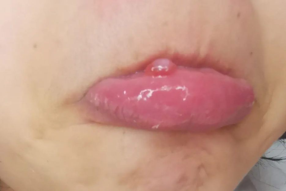 口唇囊肿