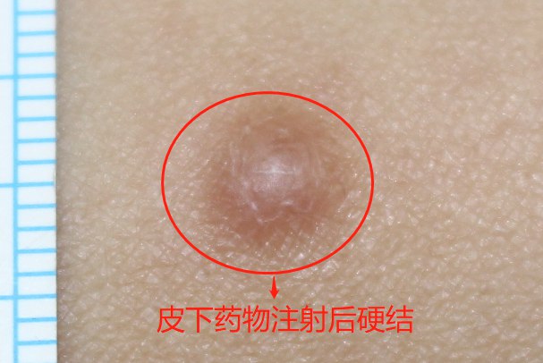 皮下药物注射后硬结