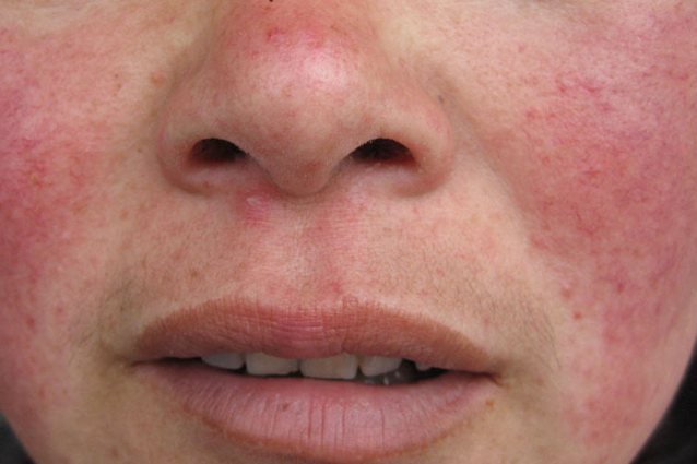 表皮与真皮变薄