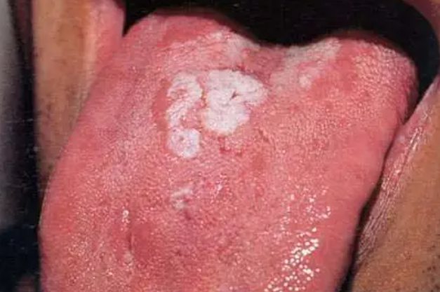 二期梅毒口腔舌头症状