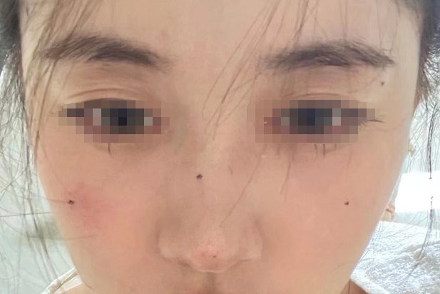 人工种痣效果图