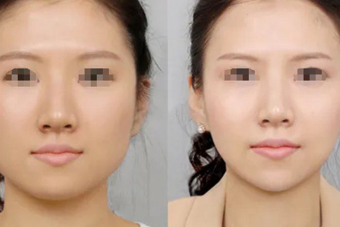 打肉毒素前后对比图