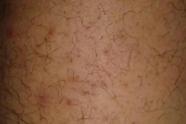 腿上毛囊炎