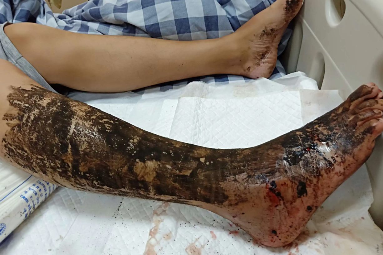 全身性中毒症状