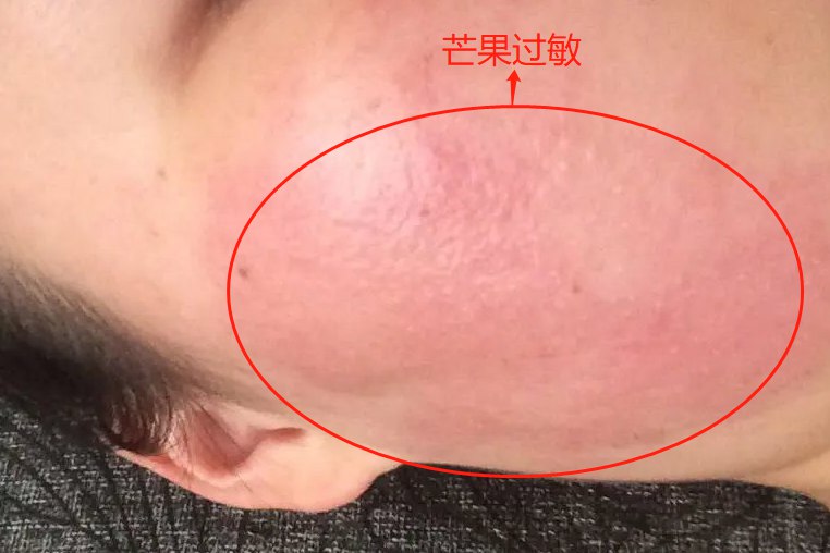 芒果过敏局部症状图片