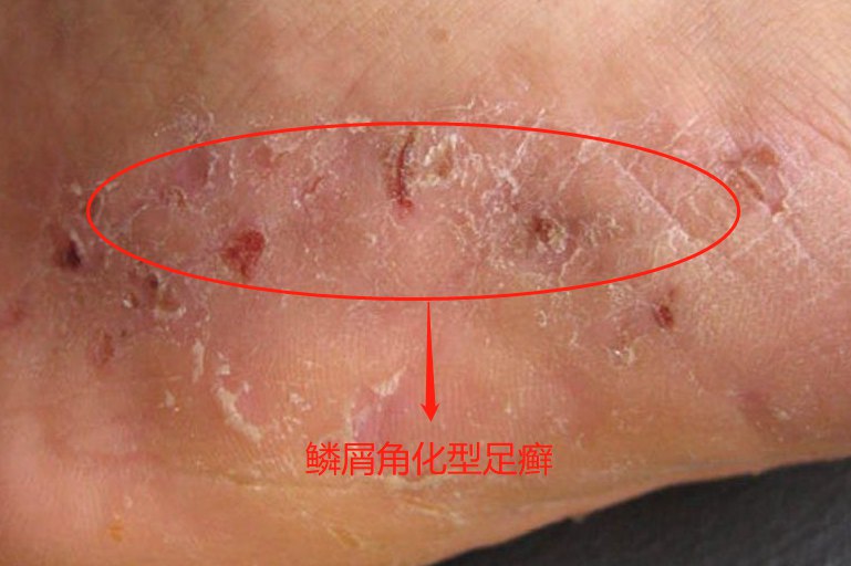 轻微角化过度型脚气