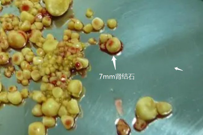 肾结石