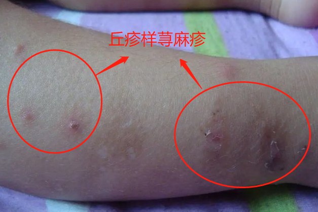 丘疹样荨麻疹图片