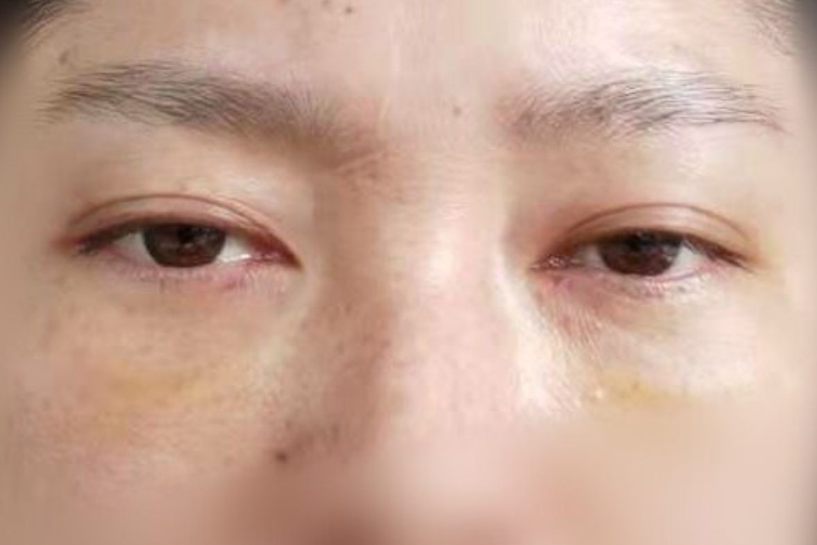 眼袋手术后图片