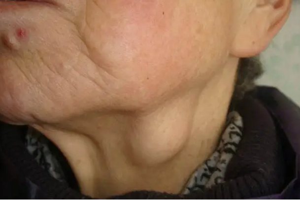 慢性颌下淋巴结肿大