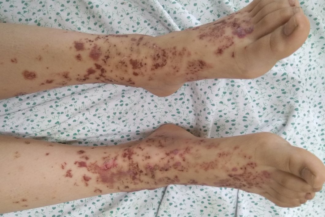 色素性紫癜性苔藓样皮炎