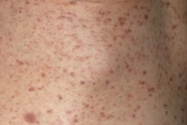 淋巴细胞性白血病皮肤图片