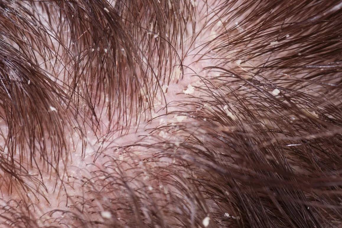巨型头皮屑