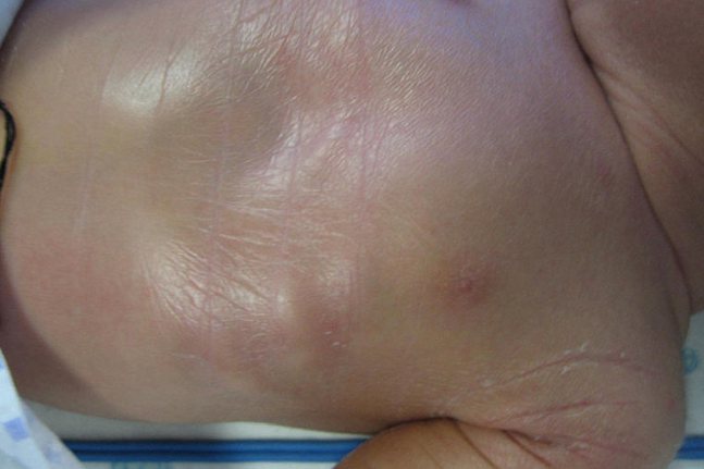 综合征型鱼鳞病