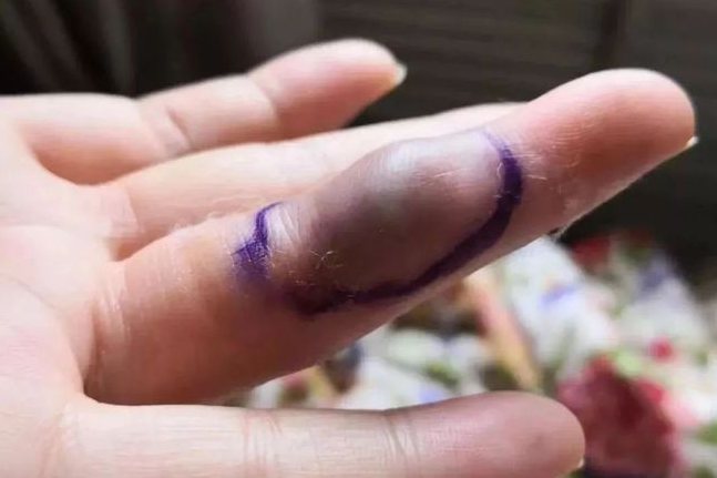 外伤撞击局部皮肤