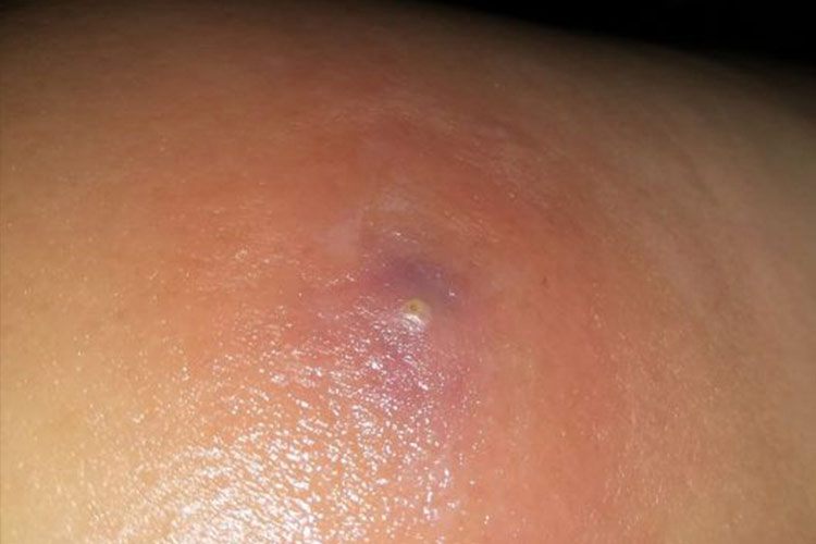 臀部的毛囊炎脓疱图