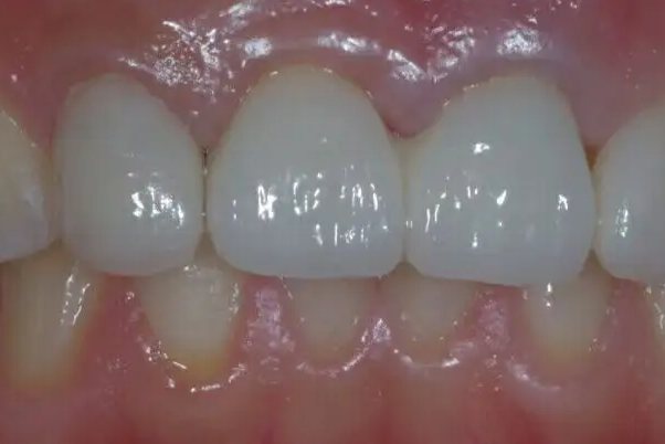 牙周病引起牙龈退缩