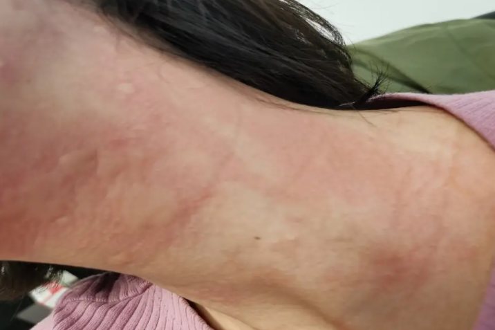 丘疹性荨麻疹