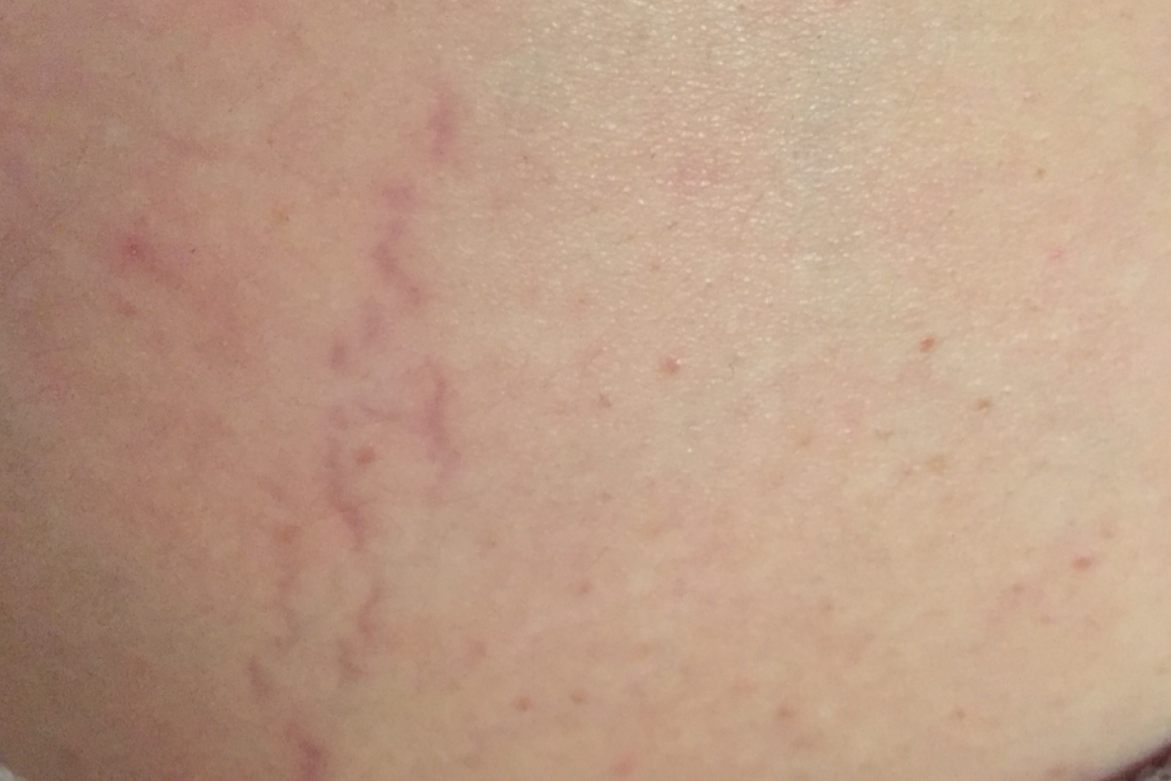 妊娠纹初期表现