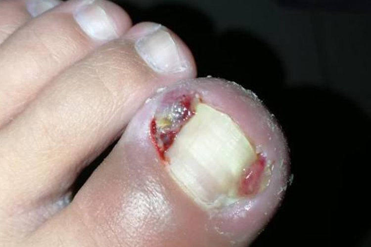 脚趾慢性甲沟炎图