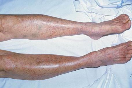 免疫性血小板减少症