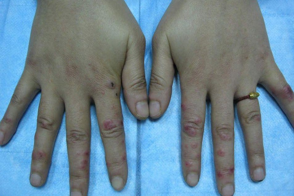 支原体感染靶形皮损