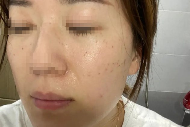 激光祛斑20天变化