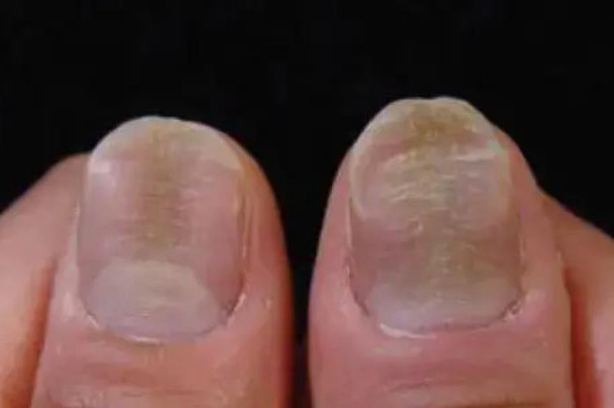 营养不良甲分离症