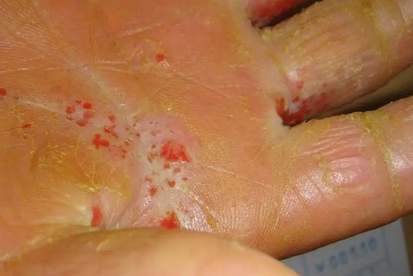 皮肤念珠菌感染