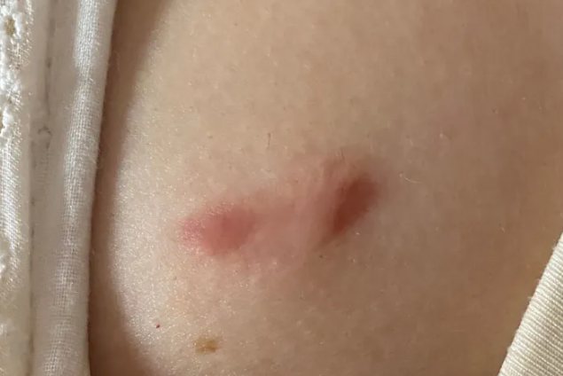 乳腺手术后疤痕图片