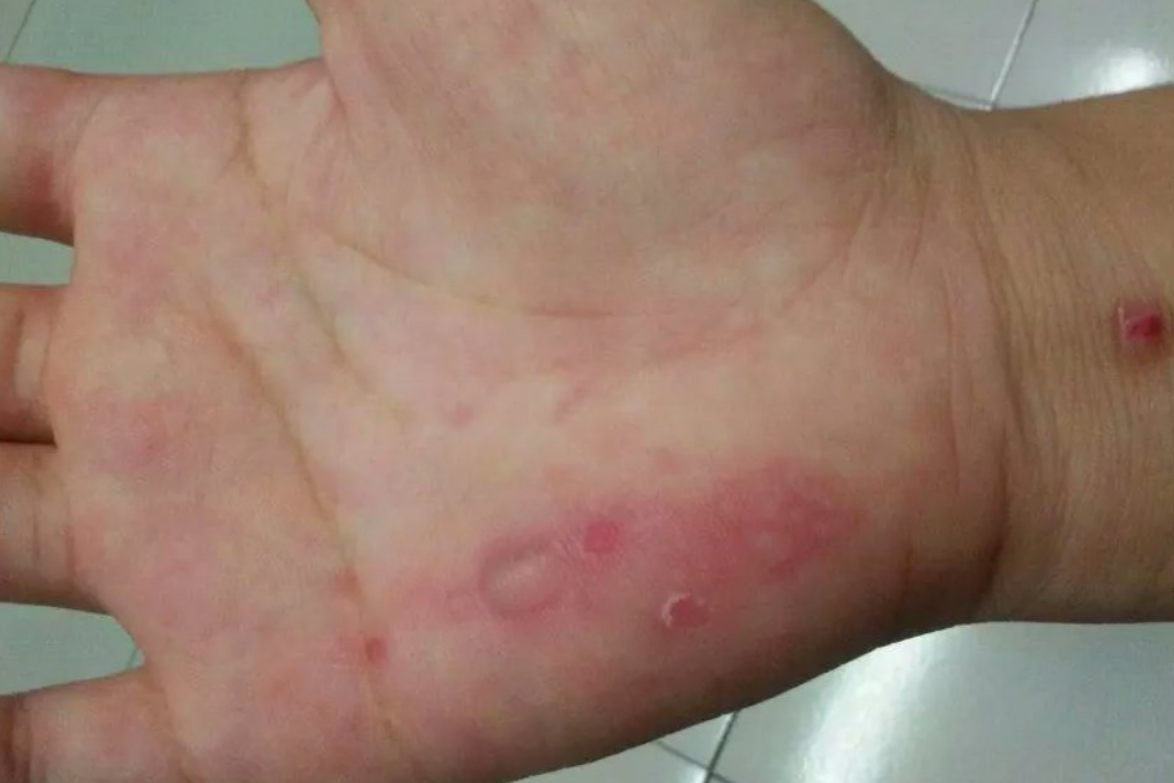 玻璃丝皮肤过敏