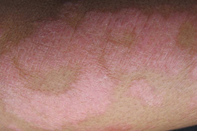 慢性斑块型银屑病