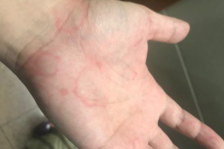 手心荨麻疹