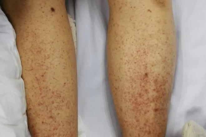 血小板减少症淤青