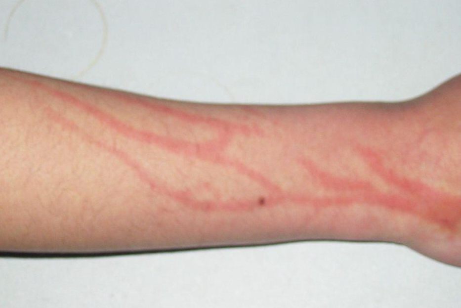 胳膊内侧浅静脉炎