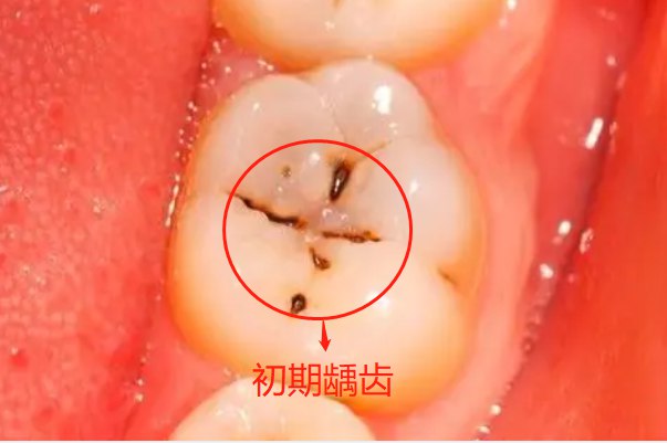 初期龋齿