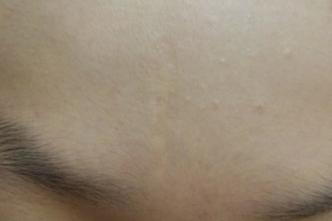 疤痕切除5年的恢复图片