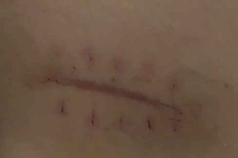 正常拆线后的疤痕