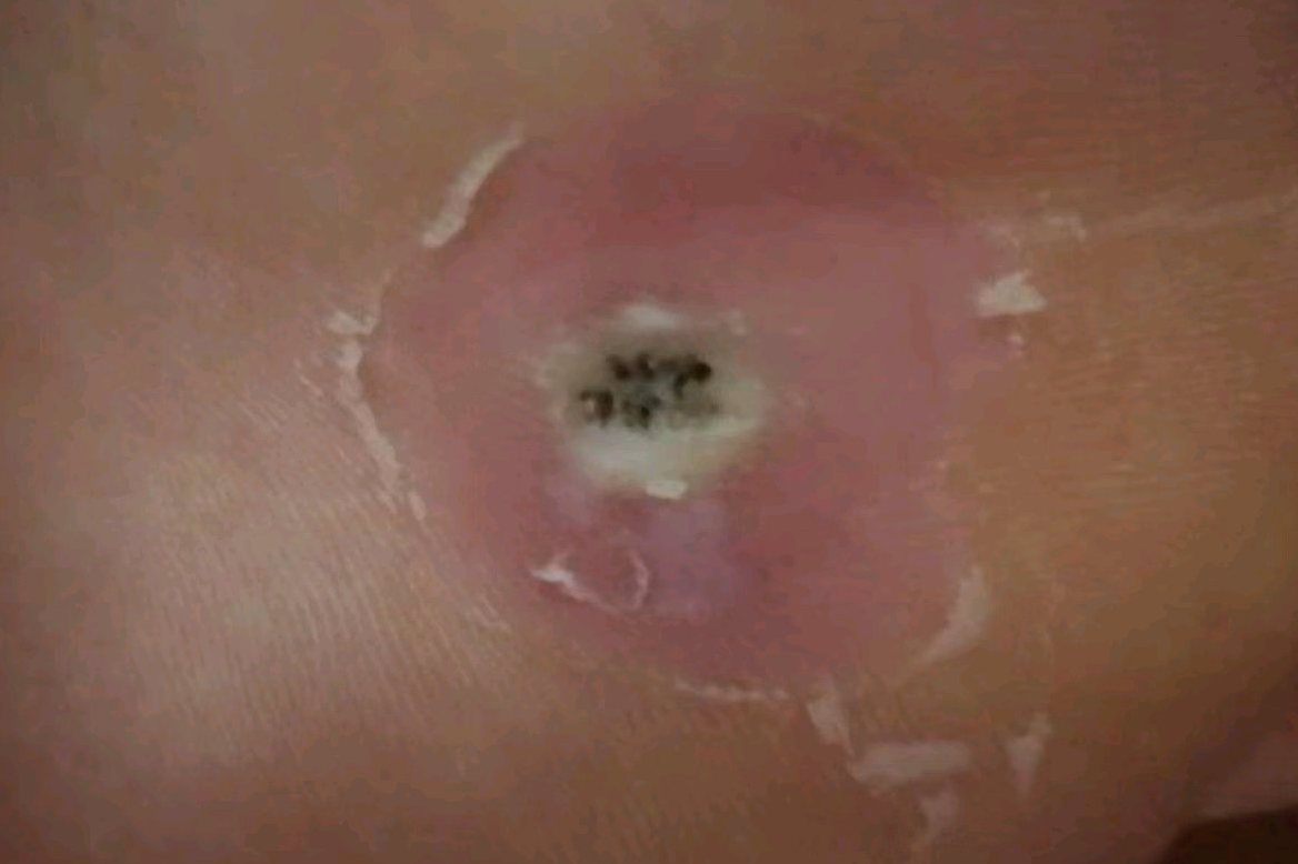 第一层死皮褪去后状态