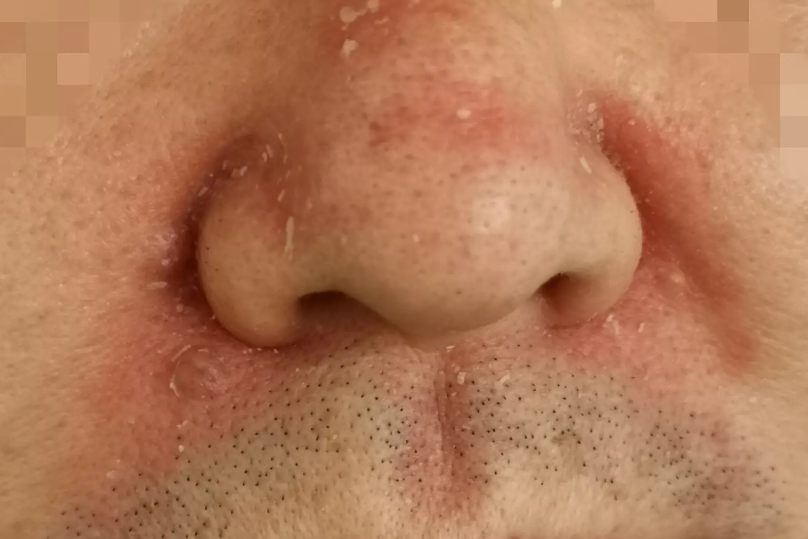 脂溢性皮炎红斑