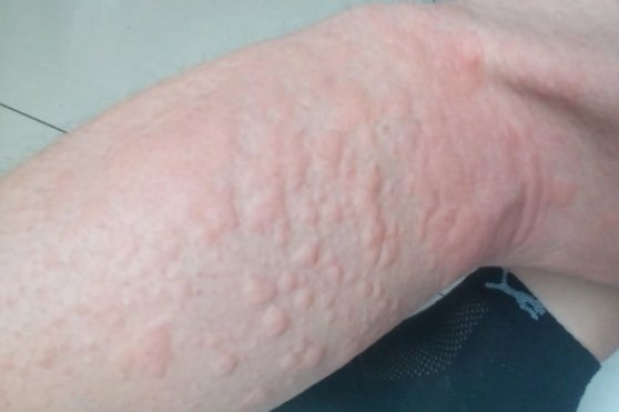 衣服过敏起红疙瘩