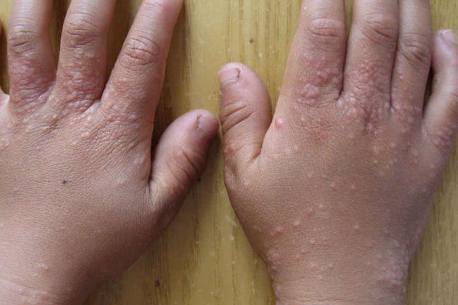 摩擦性苔藓样疹