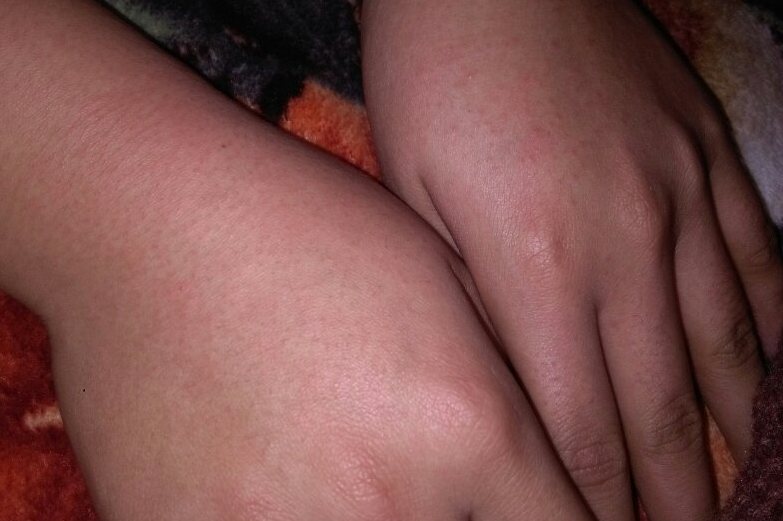 迟发型过敏反应