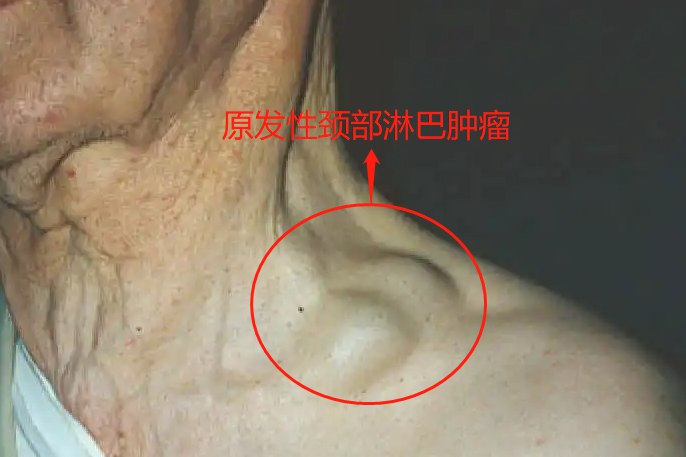 原发性颈部淋巴肿瘤